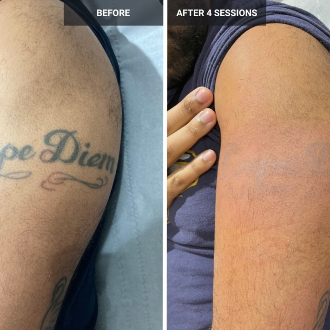 Tattoo Removal: A Fresh Start for the New Year - Infinity Med-i-Spa