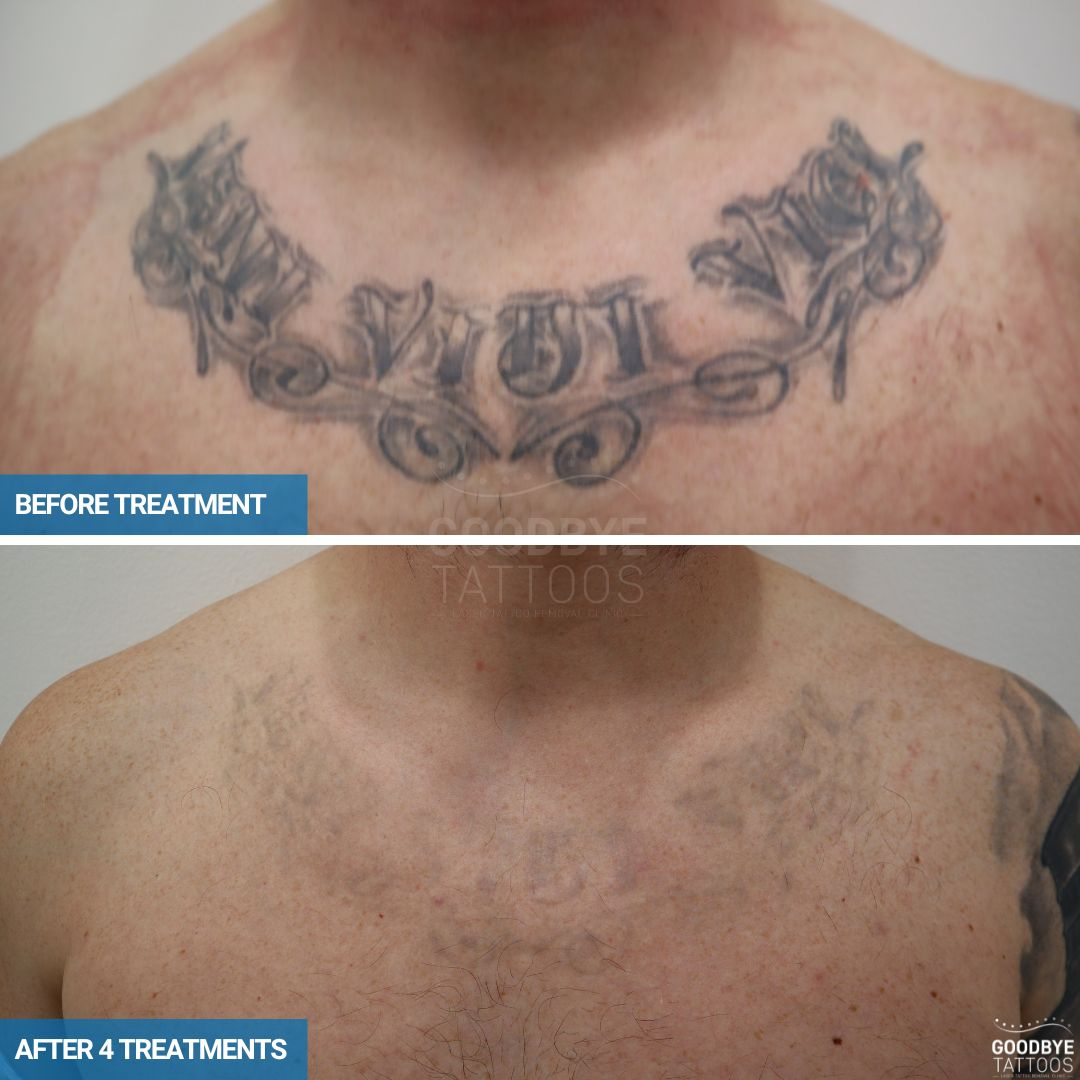 Rancho Mirage CA Laser Tattoo Removal Painless With No Down Time Med Spa